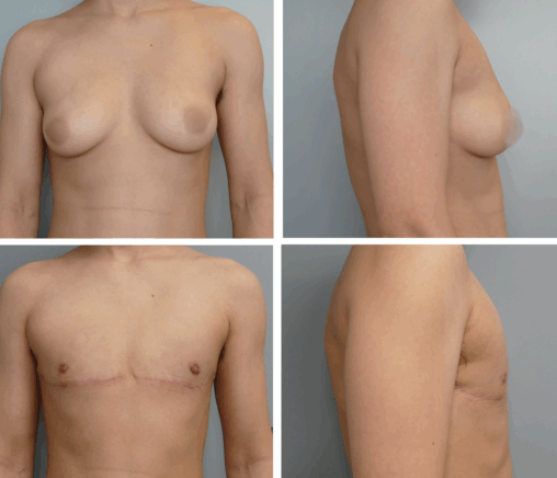 Top Surgery Portland Oregon Before and After by Dr. Tina Jenq